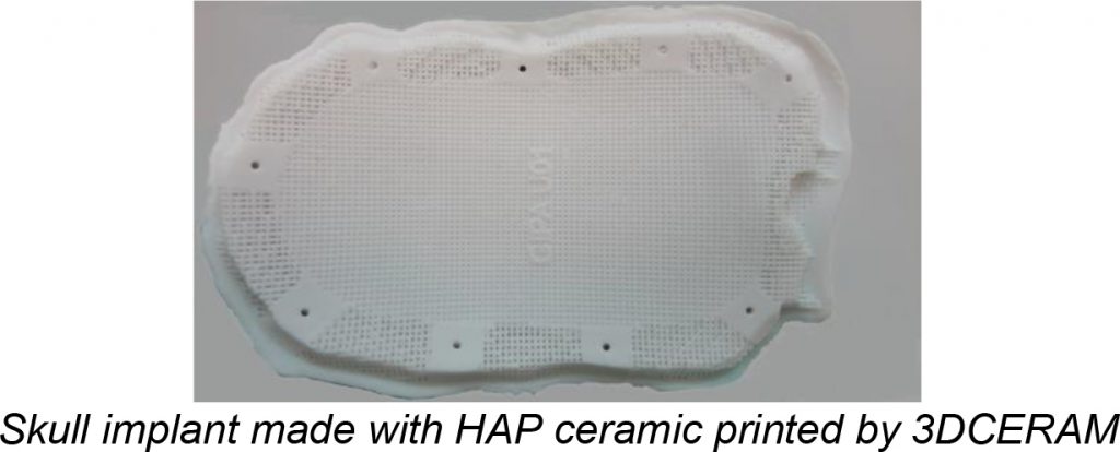 Skull implant made with HAP ceramic printed by 3DCERAM