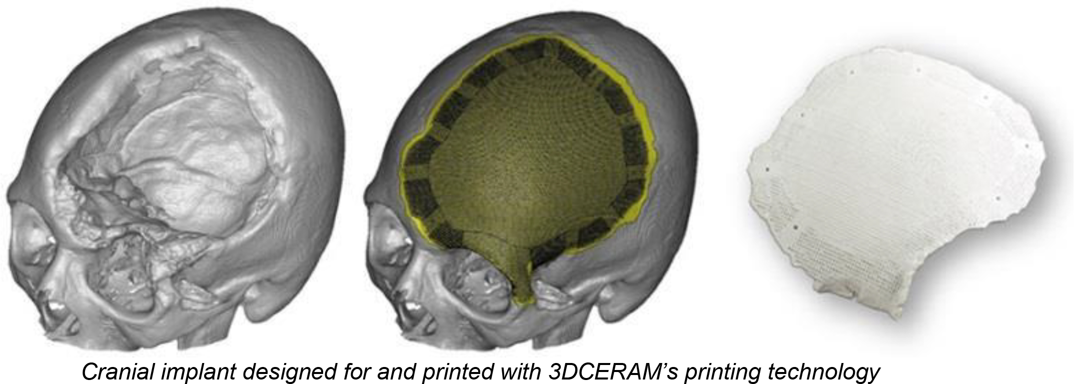 Cranial implant designed for and printed with 3DCERAM’s printing technology